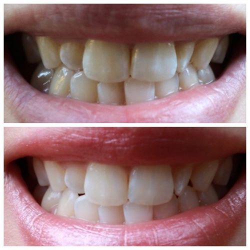 Whitening Sensitive Teeth at Home With Smile Brilliant Plus Giveaway 19 Smile Brilliant Teeth Whitening at home before and after